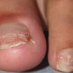 Will Vicks Make My Toenail Fall Off