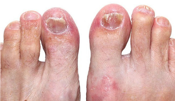 Emuaid Reviews For Nail Fungus 2021