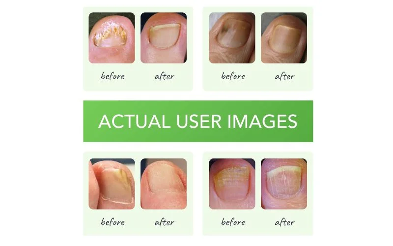 Should You Try Funginix?