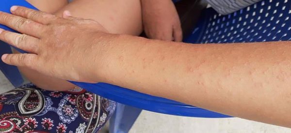 Emuaid Reviews For Eczema